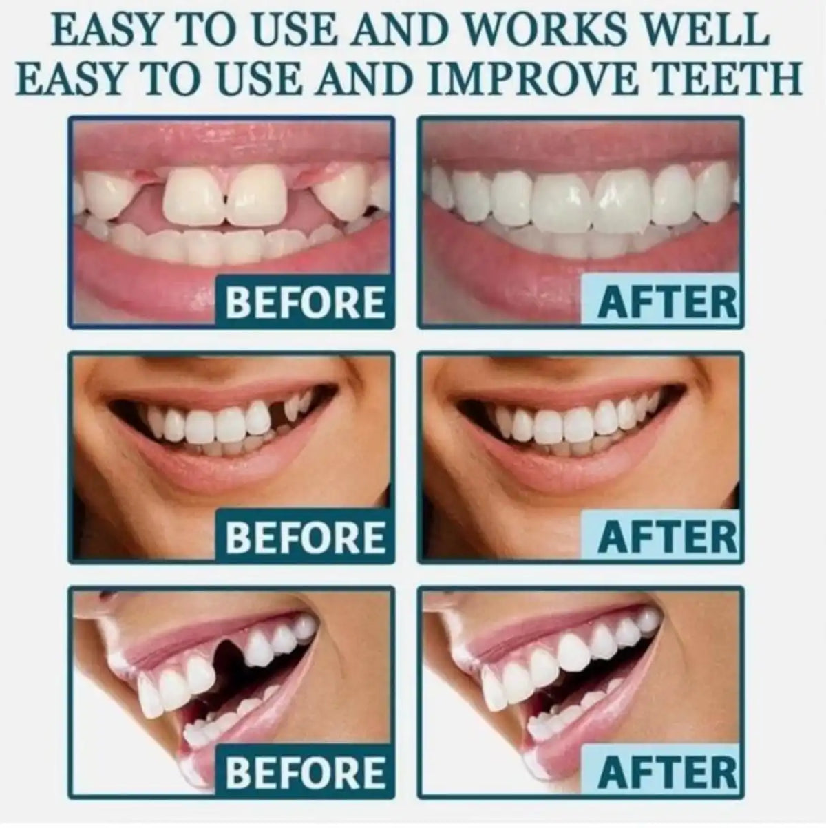 طقم أسنان مؤقت قابل للتعديل: حل تجميلي فوري Kit Prothèse Dentaire Temporaire Réglable, Solution Esthétique Instantanée