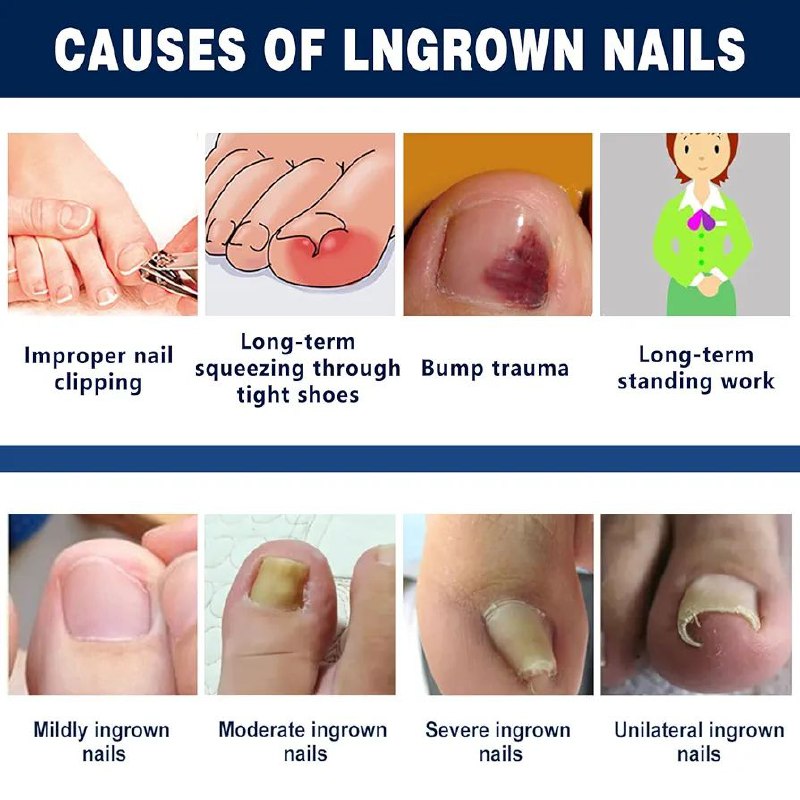 Patchs de correction pour ongles incarnés رقعة تصحيحية لأظافر القدمين النامية تحت الجلد