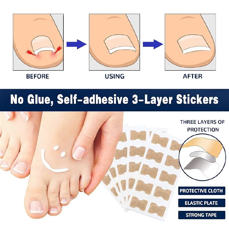 Patchs de correction pour ongles incarnés رقعة تصحيحية لأظافر القدمين النامية تحت الجلد