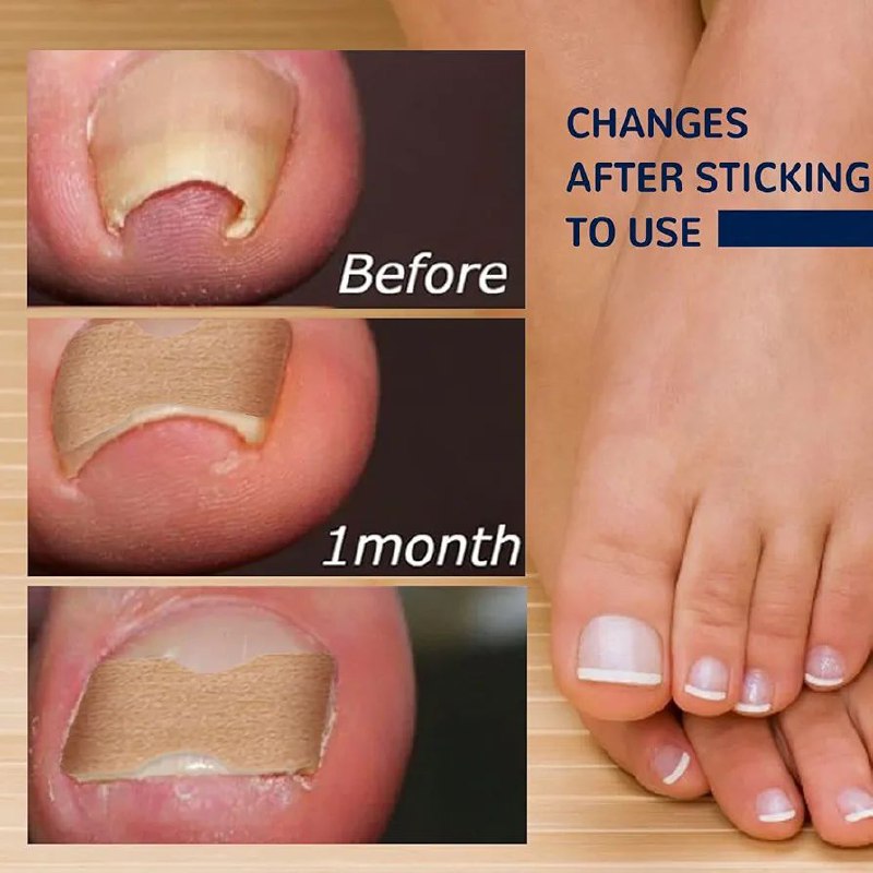 Patchs de correction pour ongles incarnés رقعة تصحيحية لأظافر القدمين النامية تحت الجلد