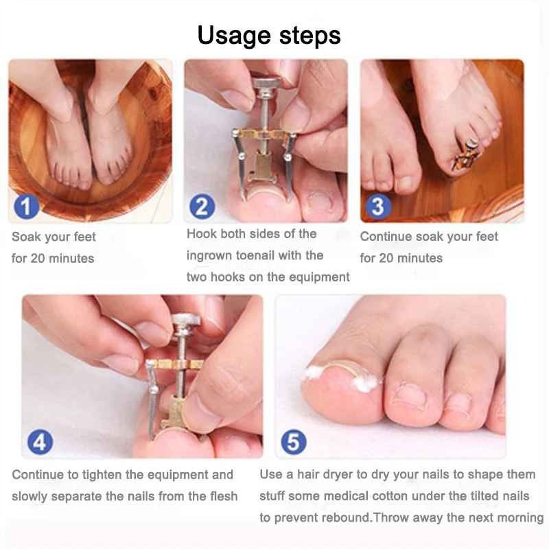 أداة تصحيح أظافر القدم الغارزة في اللحم Outil d'ongle Incarné de Correction de Style D'ongle