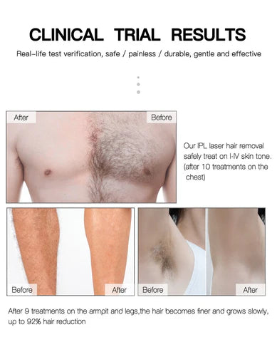 جهاز إزالة الشعر بالليزر عالي الجودة، نظام إزالة الشعر بتقنية Machine Epilateur laser haute qualité système d'épilation IPL